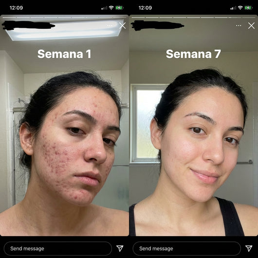 Clinical-Grade Acne Scar Stick